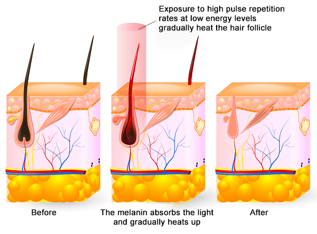 SHR permanent hair reduction hair cycle infographics viederma