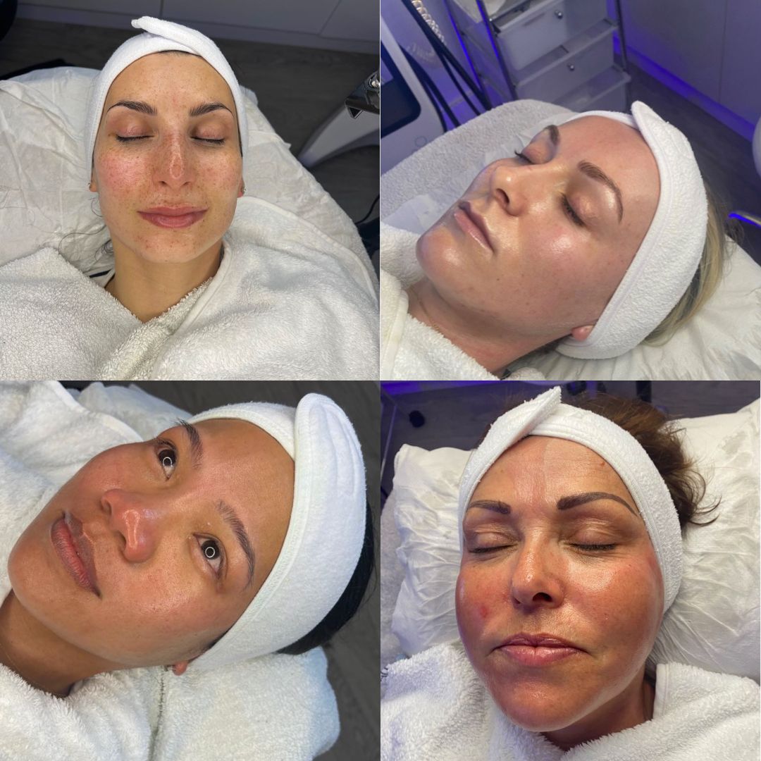 before and afters facials viederma