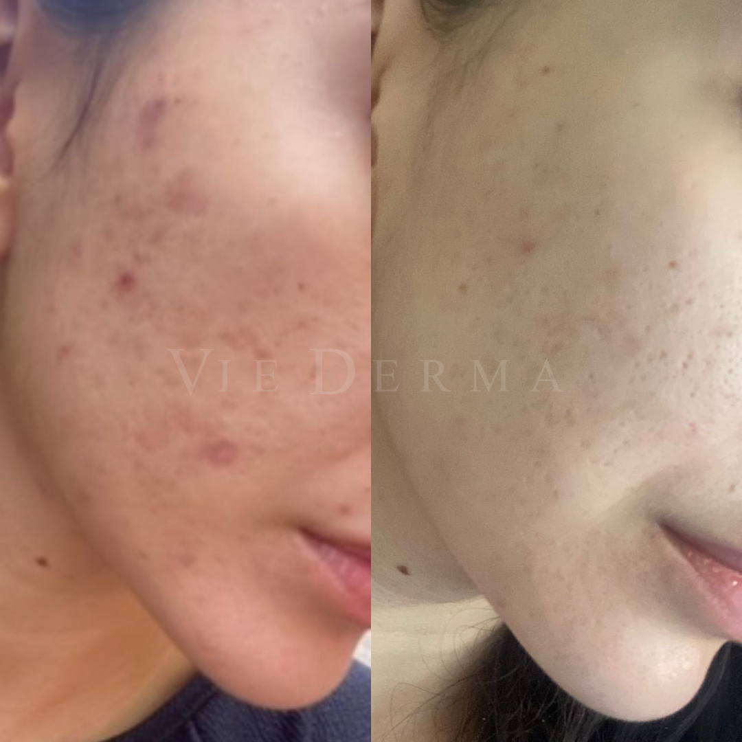 facials before and after viederma 2