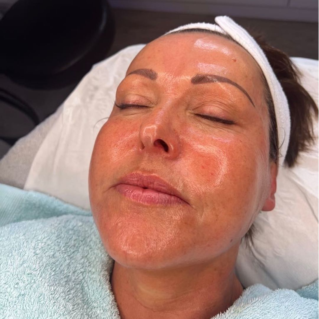 before and afters facials viederma 7