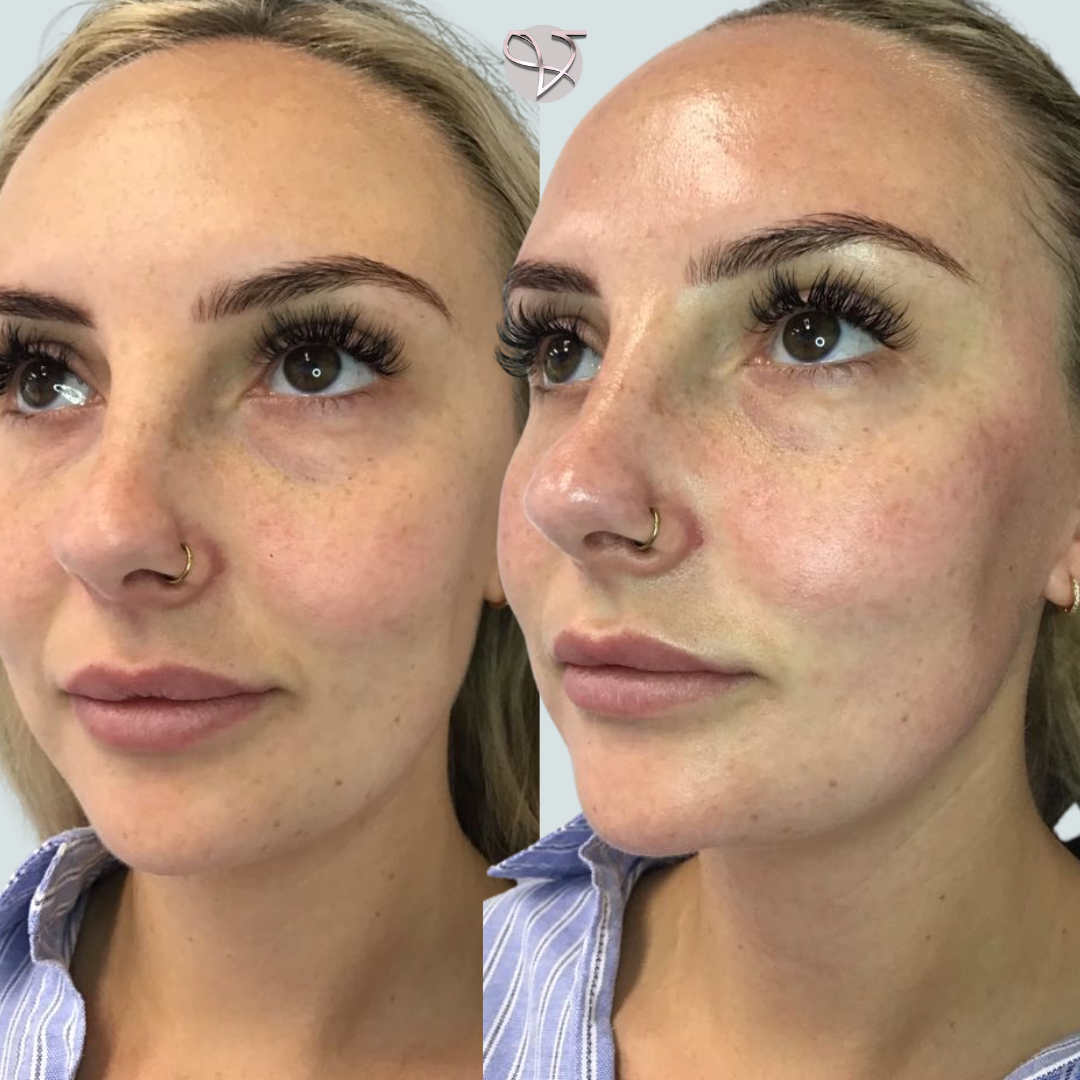 facials before and after viederma 3