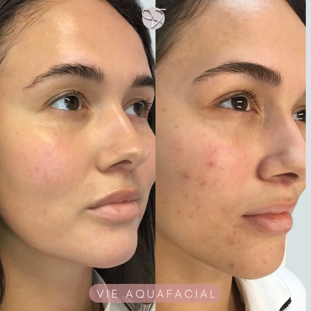 facials before and after viederma 1